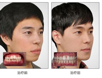 深圳如何矫正牙齿前突？