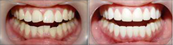 烤瓷牙修复牙齿不齐的优势有哪些？