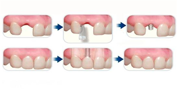 种植牙的周期是怎样的？