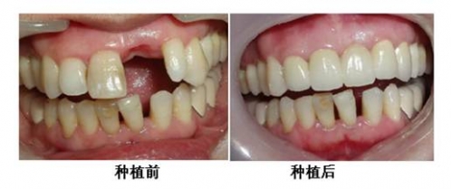 牙齿缺失多久可以做种植牙？