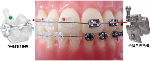 牙齿矫正哪些方法比较有效？