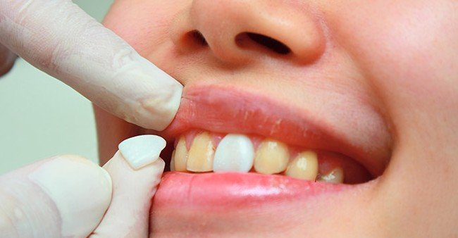 牙齿做瓷贴面的步骤是什么？