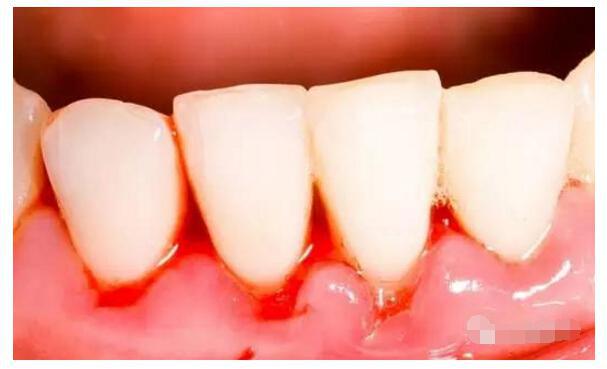 洗牙后牙龈出血是怎么回事？