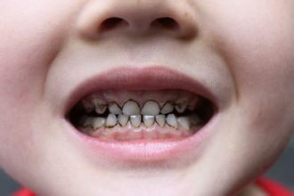 宝宝牙齿变黑是有蛀牙吗？