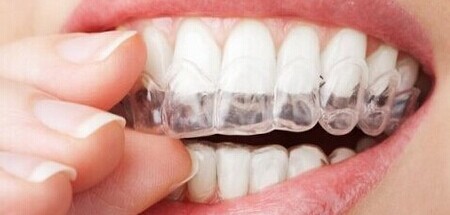 隐形牙齿矫正的优点有哪些？
