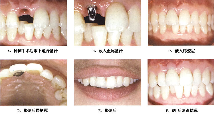 种植牙的主要步骤有哪些？