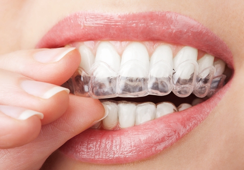 牙齿矫正需要戴多久的牙套？