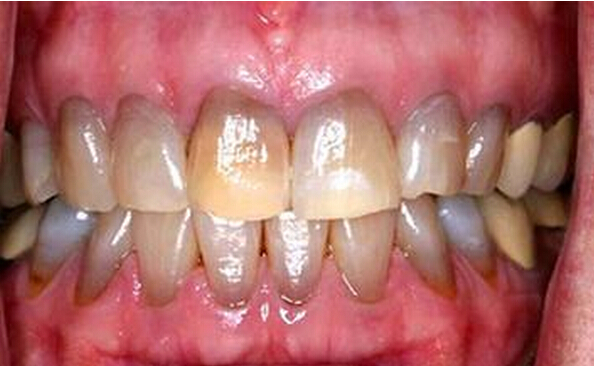 哪些方法能预防四环素牙？