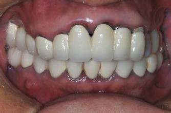 装烤瓷牙后为什么会出现牙龈着色？