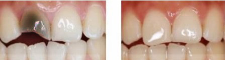 烤瓷牙后为什么会出现牙齿断裂？
