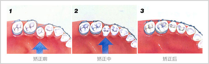牙齿矫正多久复查一次？