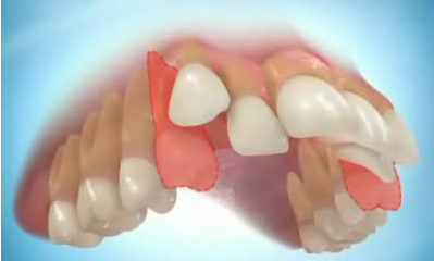 牙齿矫正哪些情况需要拔牙？