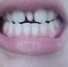 门牙中间有多生牙需要拔掉吗？