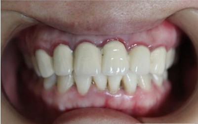 烤瓷牙牙龈出血怎么修复？