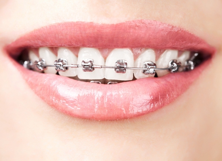 不同的牙齿矫正方式优缺点是什么？