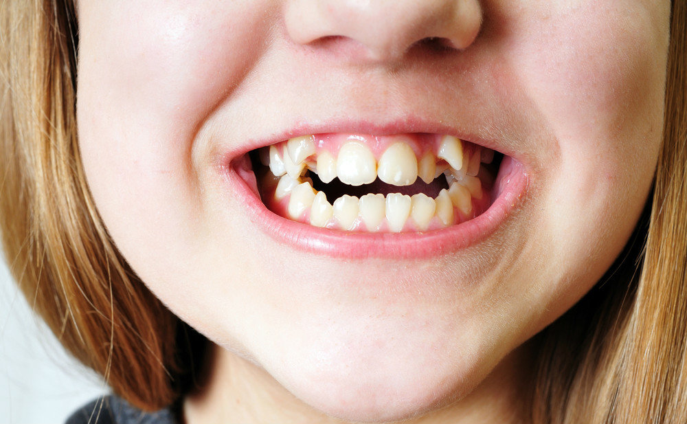 乳牙龋齿不治疗有哪些影响？