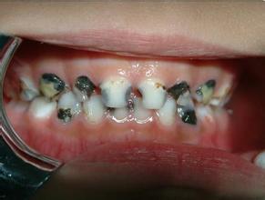 为什么儿童更易患龋齿？