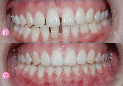 如何有效矫正牙齿间隙？