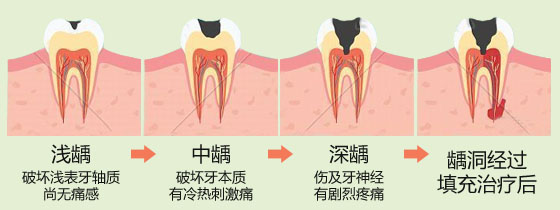 蛀牙有哪些症状和危害？