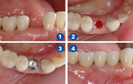 种植牙术后多久可以恢复？