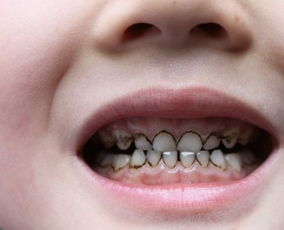 孩子乳牙发黑是蛀牙吗？