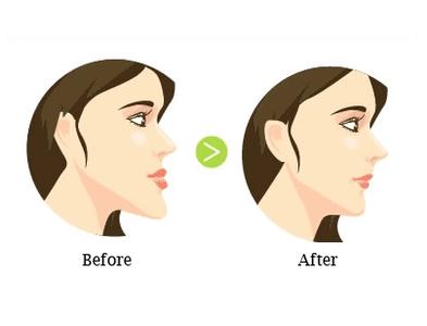 女性做牙齿矫正能改变脸型吗？
