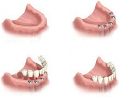 半口种植牙后疼痛的原因是什么？