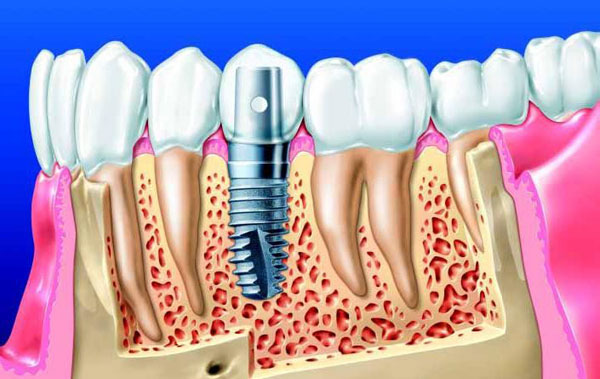 种植牙保养维护的方法有哪些？