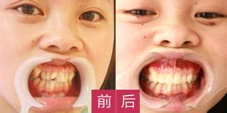 牙齿轻微不齐需要矫正吗？