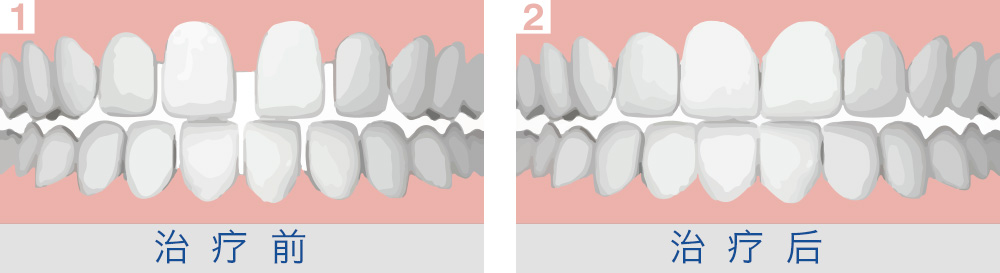 如何预防牙齿稀疏？
