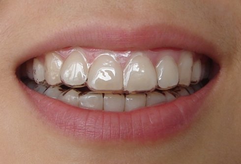 牙齿矫正后需要注意些什么？