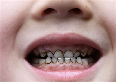 幼儿龋齿有哪些症状？