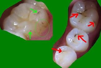 牙菌斑是如何形成牙结石的？