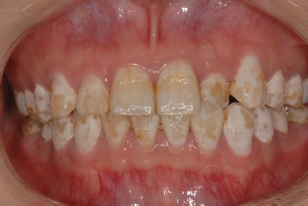 氟斑牙的危害主要有哪些？