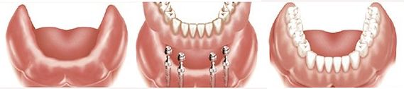 全口种植牙的禁忌症有哪些？