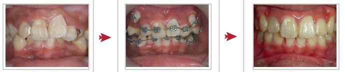 牙齿正畸治疗的过程是怎样的？