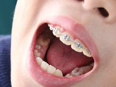 儿童牙齿矫正一般需要多长时间？
