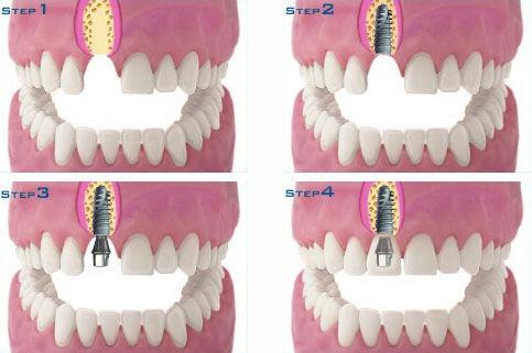 单颗牙缺失怎么修复比较好？
