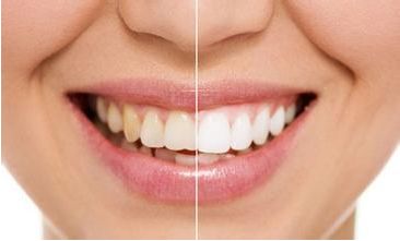 牙齿美白有哪些注意事项？