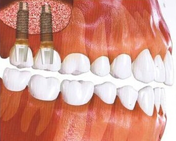 种植牙安全吗？