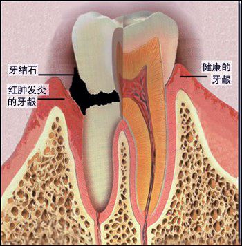 牙龈炎的外在症状有哪些？