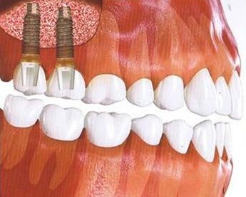 影响种植牙寿命的因素有哪些？