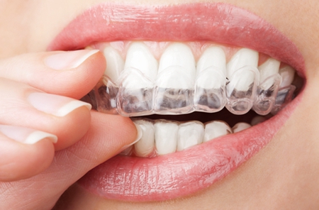 隐形牙齿矫正有哪些优点？