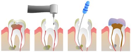 深圳牙髓炎如何治疗？