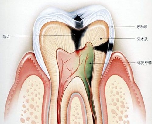 深圳牙髓炎症状