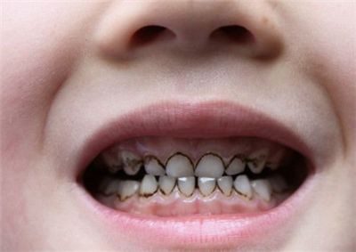 深圳儿童龋齿如何治疗
