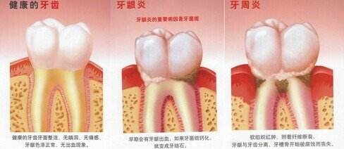 深圳得了牙龈炎怎么治？