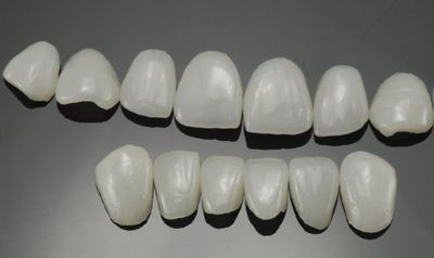 深圳牙齿瓷贴面多少钱一颗？