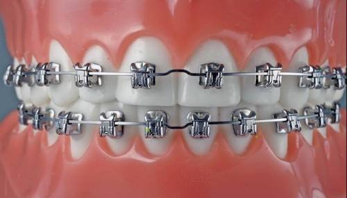 深圳自锁托槽牙齿矫正好吗？