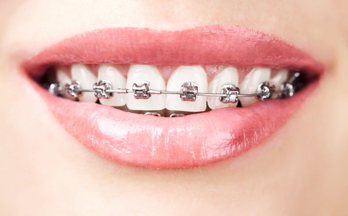深圳治疗牙齿不齐方法有哪些？